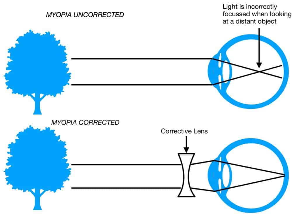 Myopia Series Part 1 - What Causes Myopia? - Artarmon Vision